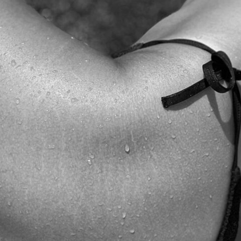 estrias-remedios-caseros