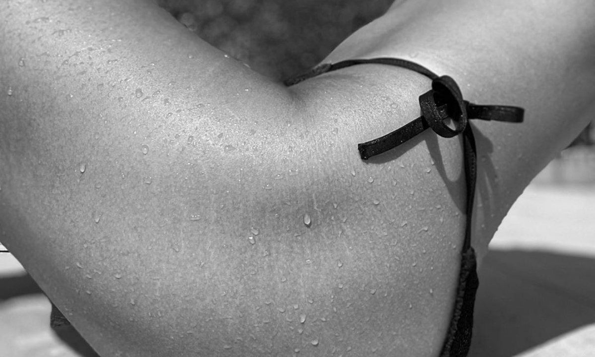 estrias-remedios-caseros