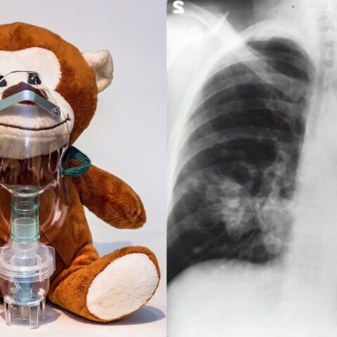 como hacer un nebulizador casero