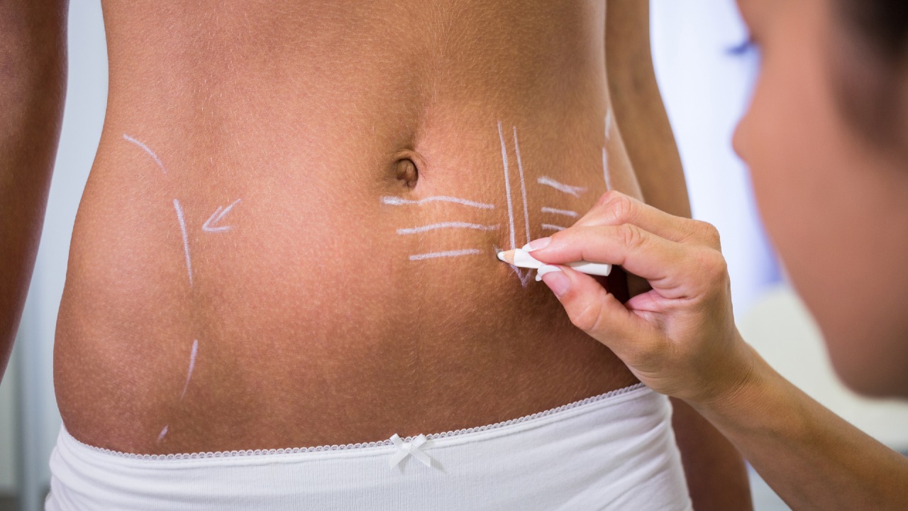 doctora trasando lipoescultura