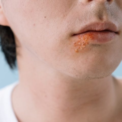 el herpes zoster es una enfermedad que no tiene cura
