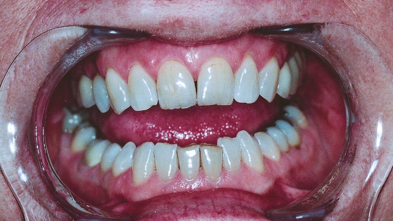 periodontitis