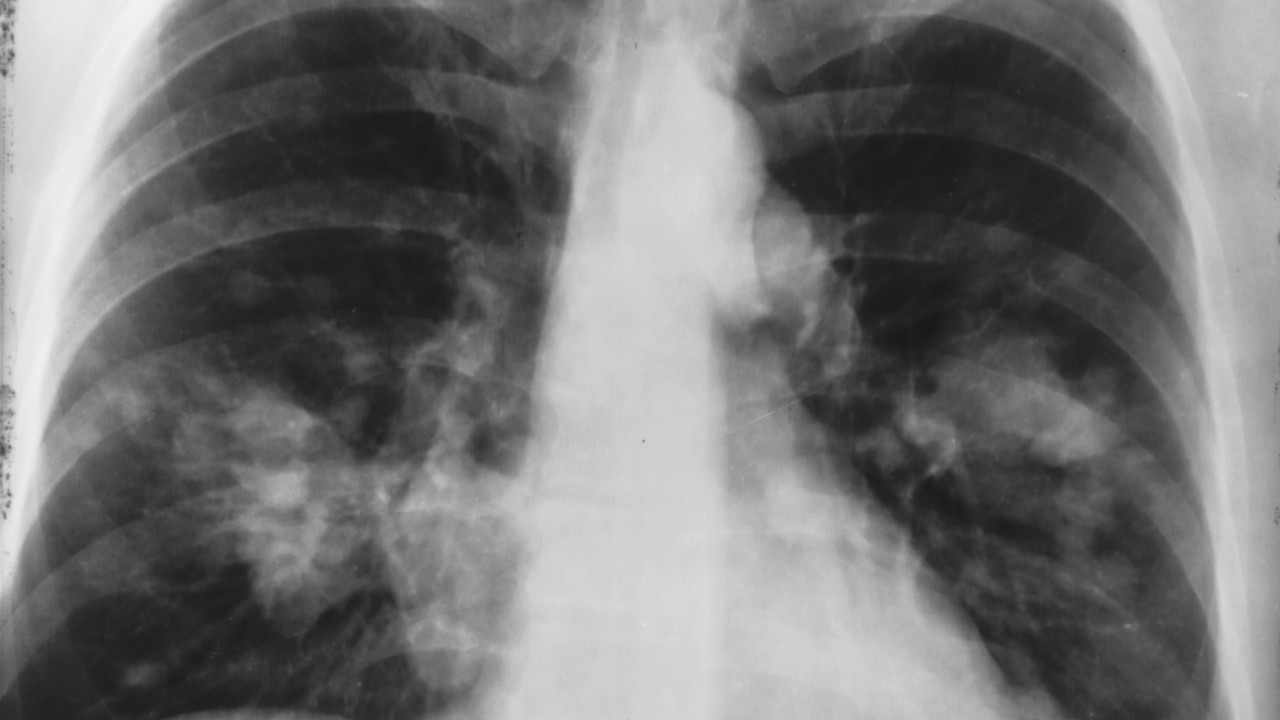 cansancio y fatiga por covid 19