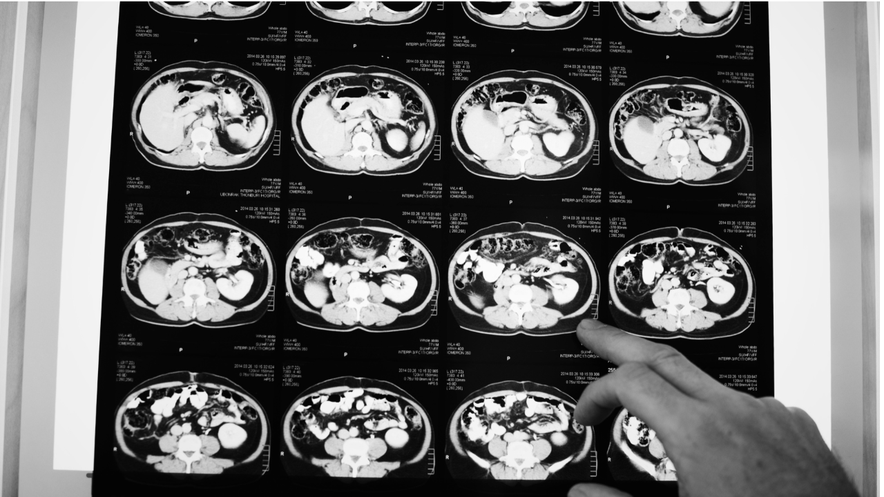 síntomas de covid en adultos mayores