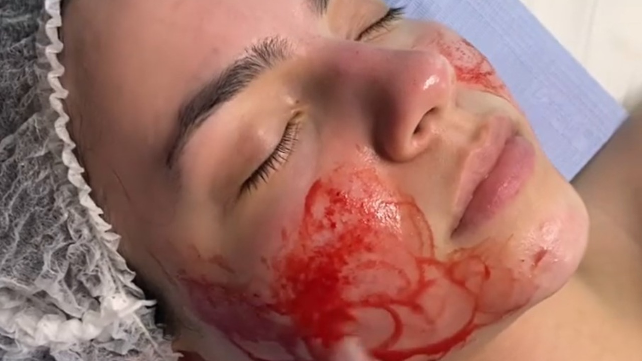 microneedling tratamiento de agujas riesgo sanitario