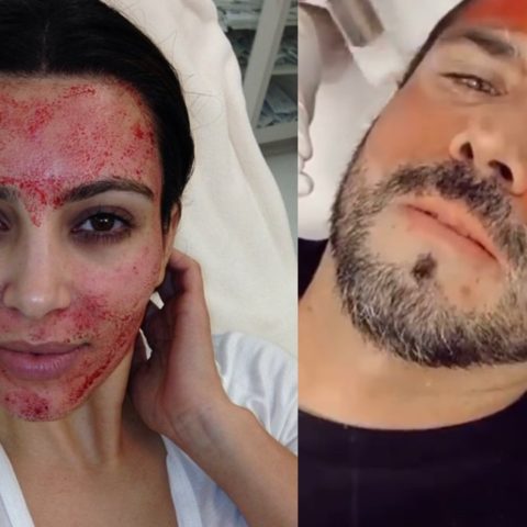 microneedling peligrosa tendencia de belleza