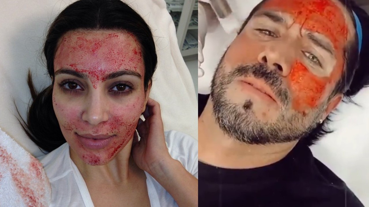 microneedling peligrosa tendencia de belleza