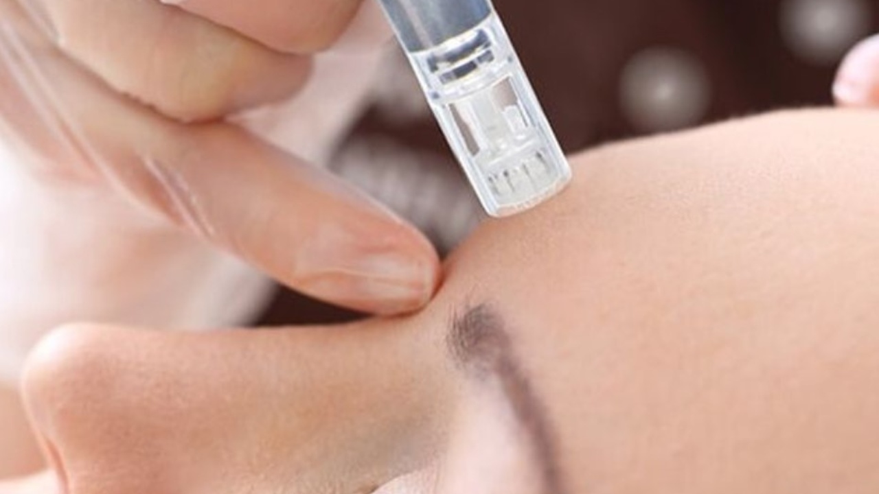 microneedling facial vampiro peligro para la piel