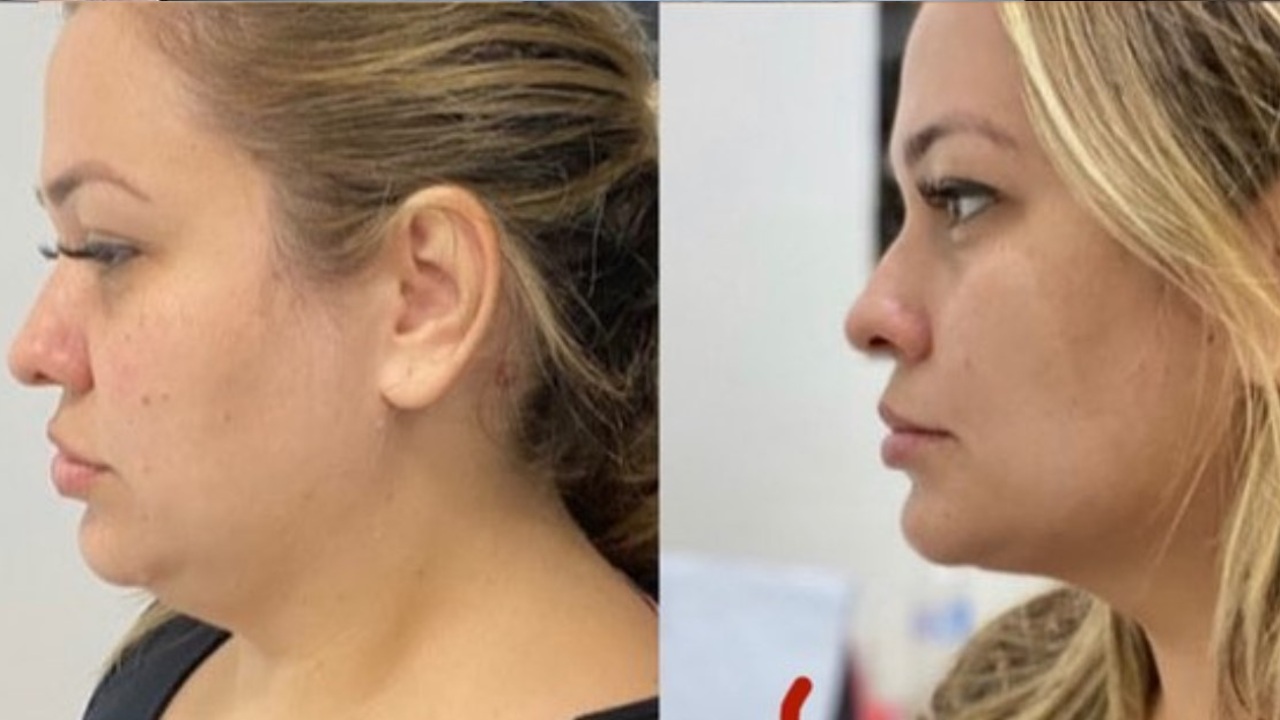 lipopapada efectos y resultados que no conocías