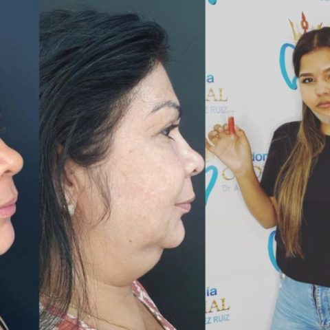 lipopapada efectos y resultados que no conocías