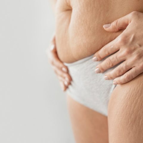 como evitar estrias en el embarazo prevenir remedios