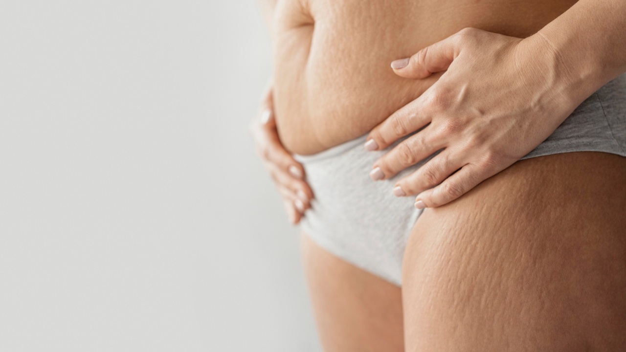 como evitar estrias en el embarazo prevenir remedios