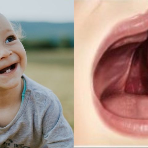 Cuáles son las causas del paladar hendido en niños