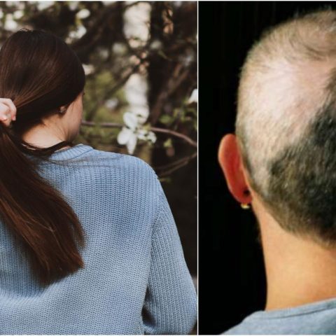 señales de alopecia areata