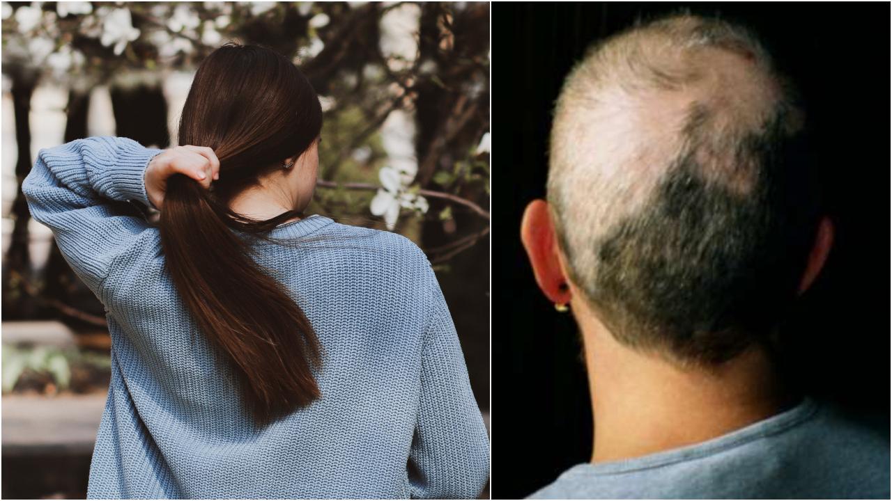 señales de alopecia areata