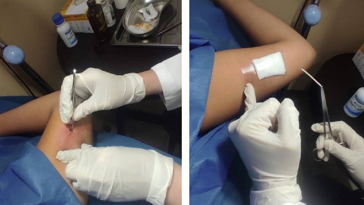 cosas que debes saber antes de ponerte un implante hormonal