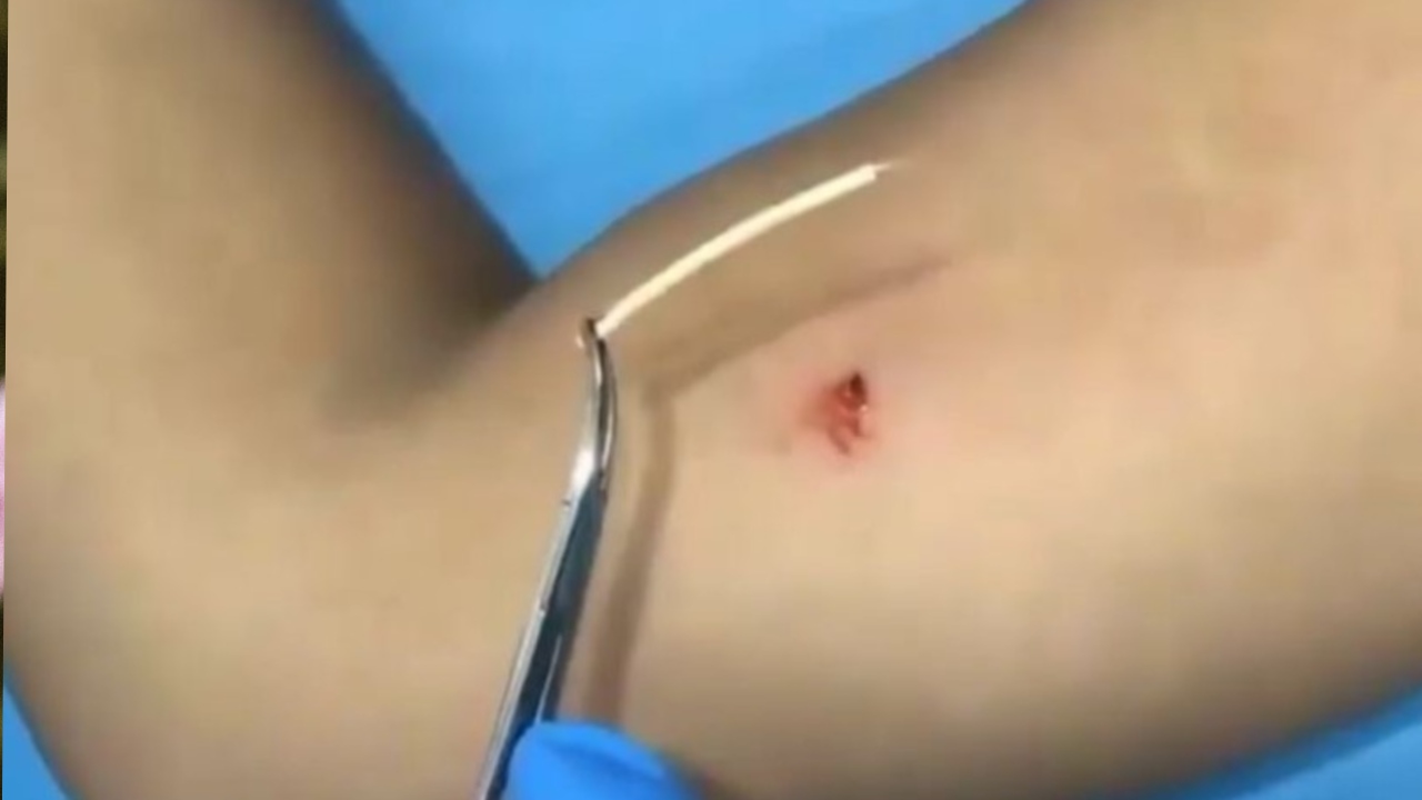 implante hormonal subdermico que es