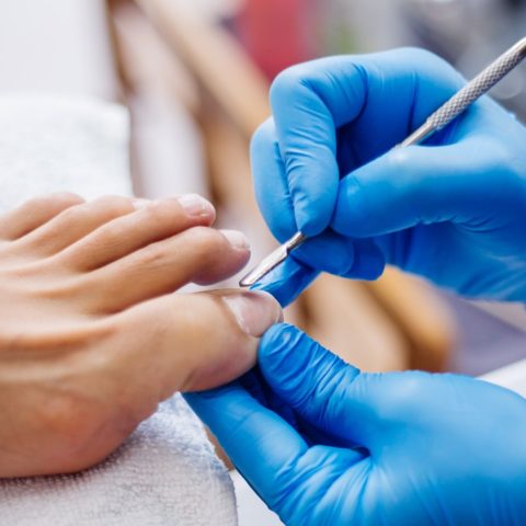 líneas blancas en las uñas