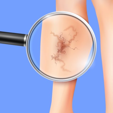 plantas que alivian las venas varicosas