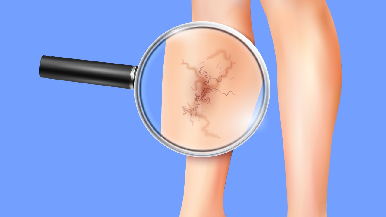 plantas que alivian las venas varicosas