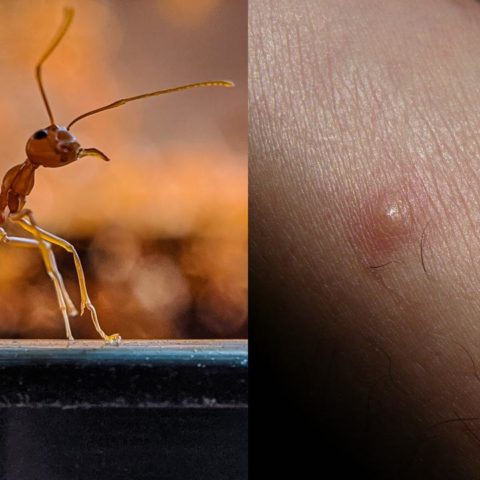 Como aliviar las picaduras de hormigas