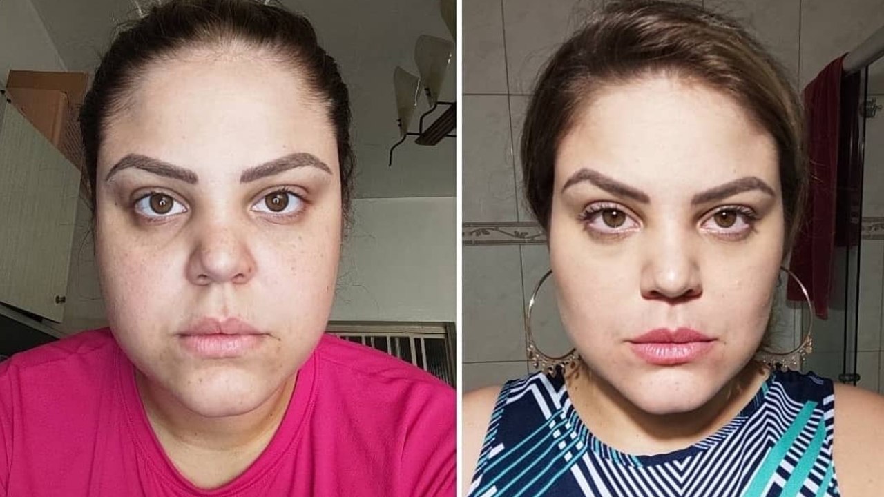 razones por las que no salió bien la bichectomía como solucionarlo