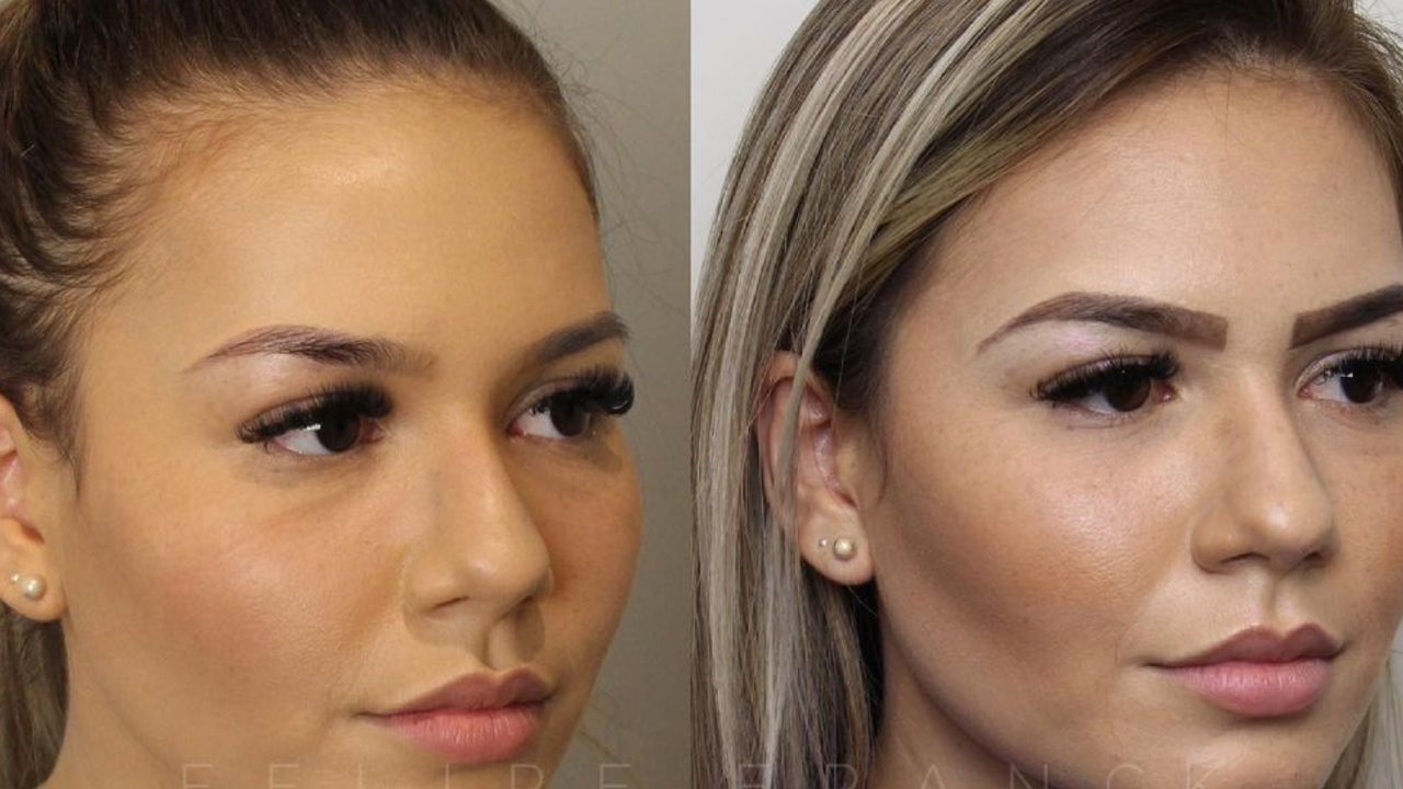 razones por las que no salió bien la bichectomía bolsas de bichat