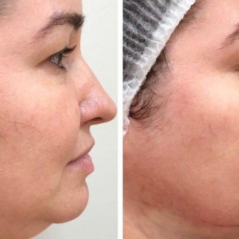 razones por las que no salió bien la bichectomía