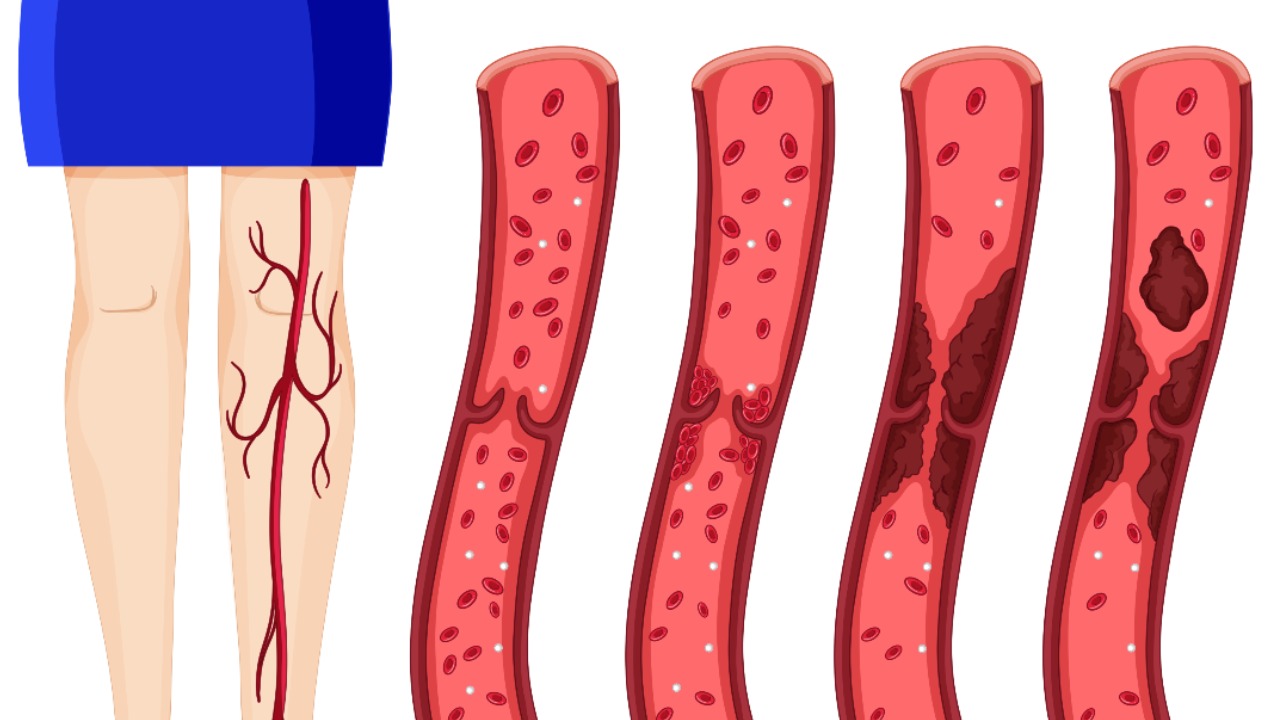 sintomas de coagulos en la sangre problemas circulatorios