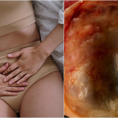 Qué comer si tienes quistes en los ovarios