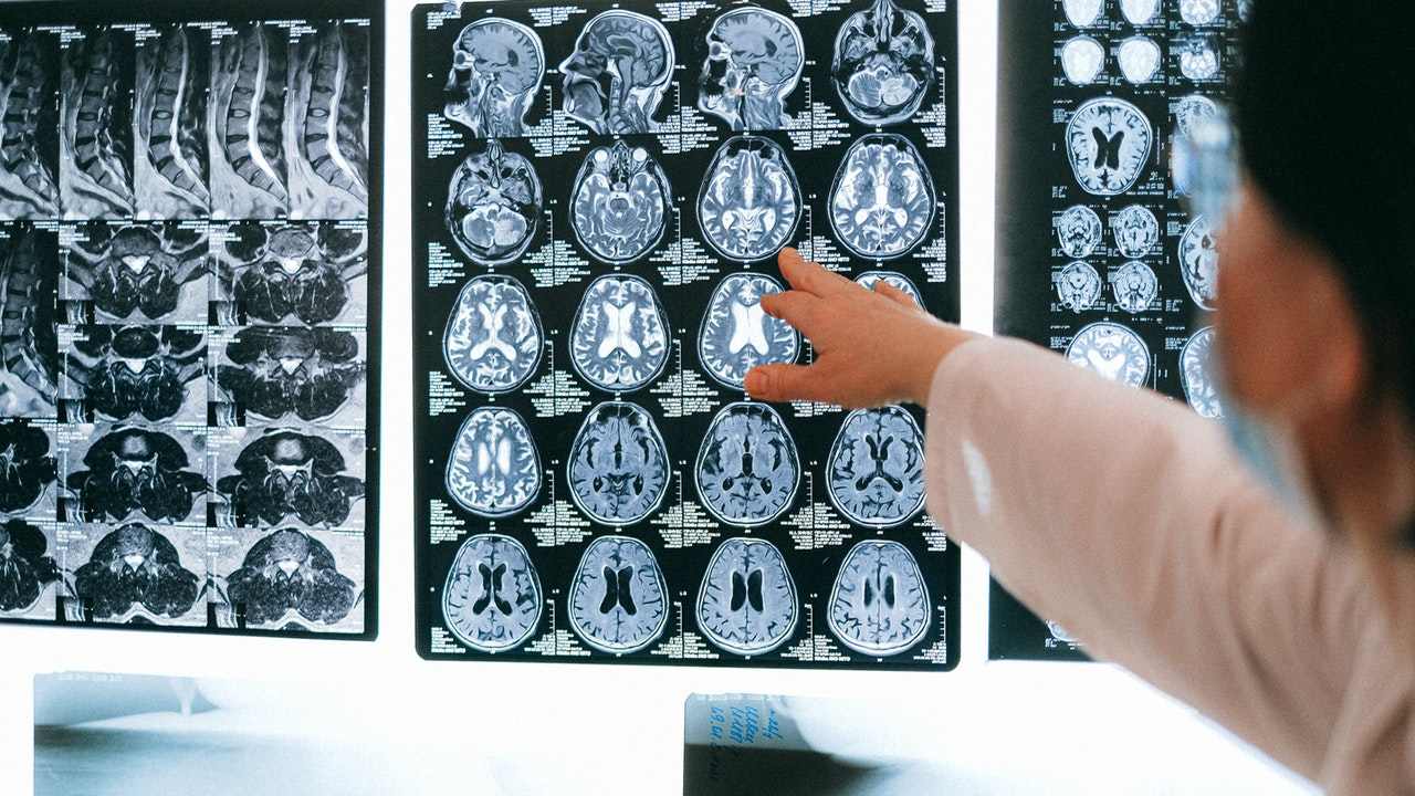 estudio relación cáncer de cerebro y heces de gato