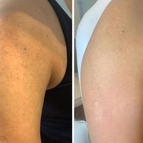 granitos en brazos nombre médico