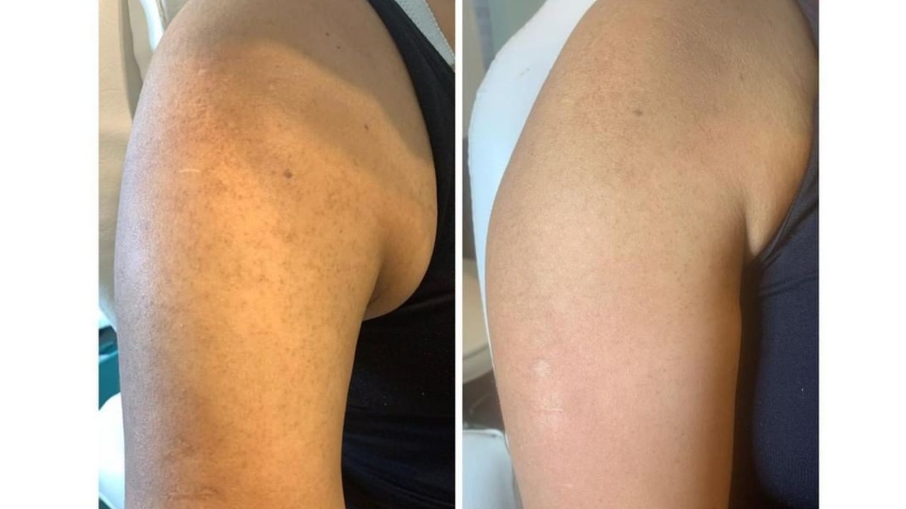 granitos en brazos nombre médico