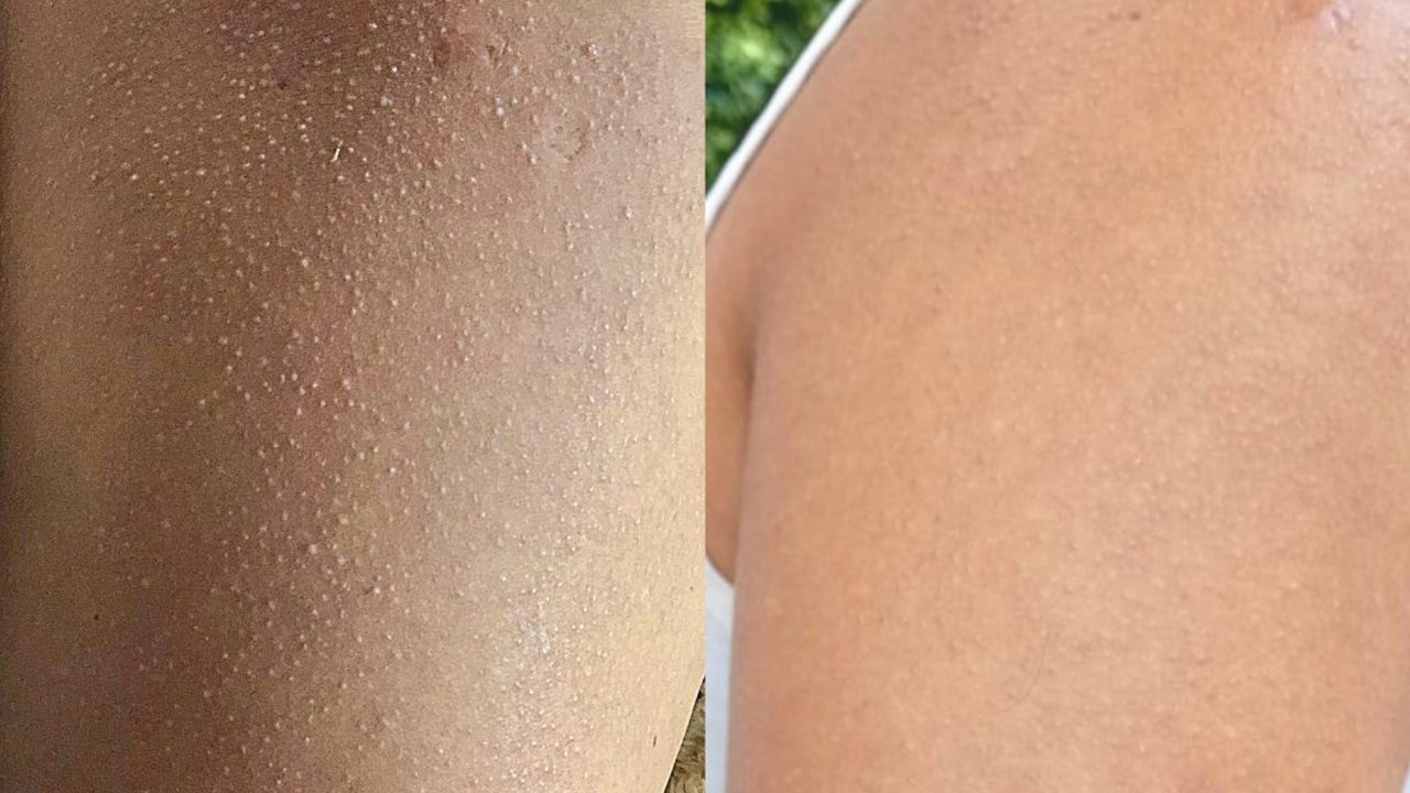 cómo quitar la piel de gallina en brazos