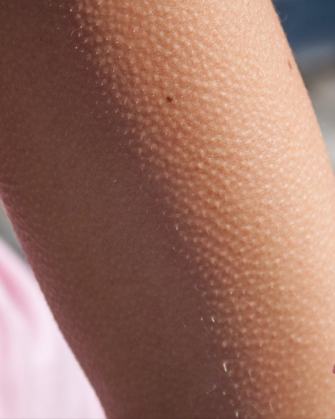 queratosis pilaris padecimiento dérmico