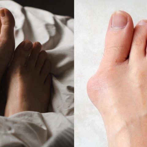 ¿Andar descanzo provoca juanetes? Por qué salen
