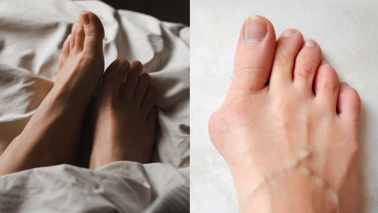 ¿Andar descanzo provoca juanetes? Por qué salen
