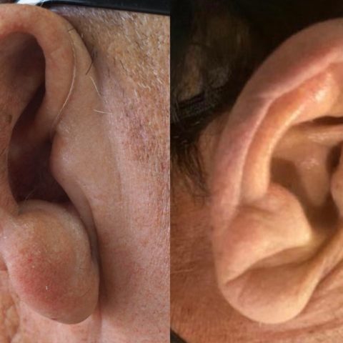 ¿Tienes un surco en el lóbulo de tu oreja?