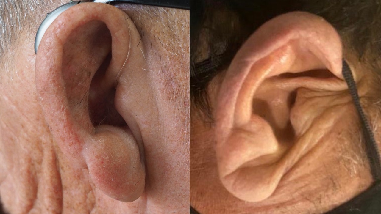 ¿Tienes un surco en el lóbulo de tu oreja?