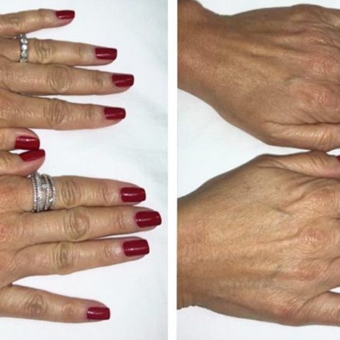 remedios contra las arrugas de las manos