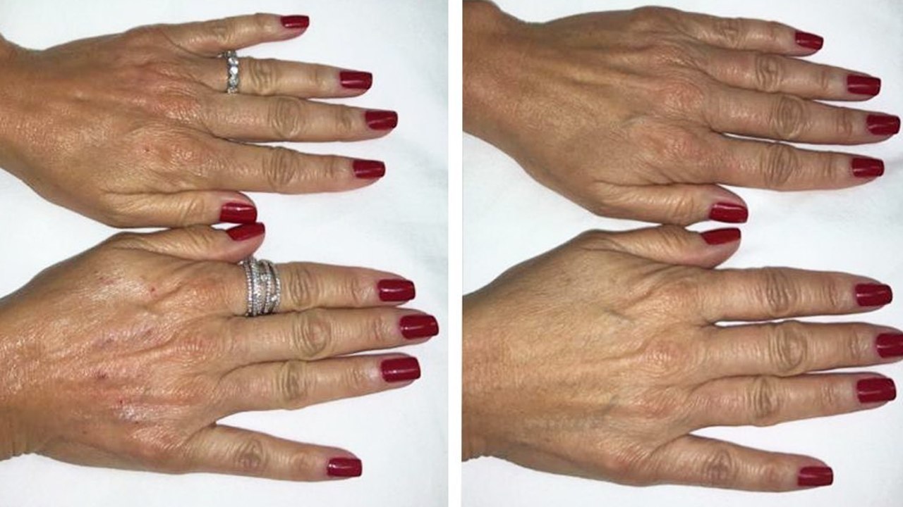 remedios contra las arrugas de las manos