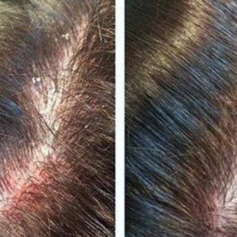 remedio casero contra la caspa con vinagre