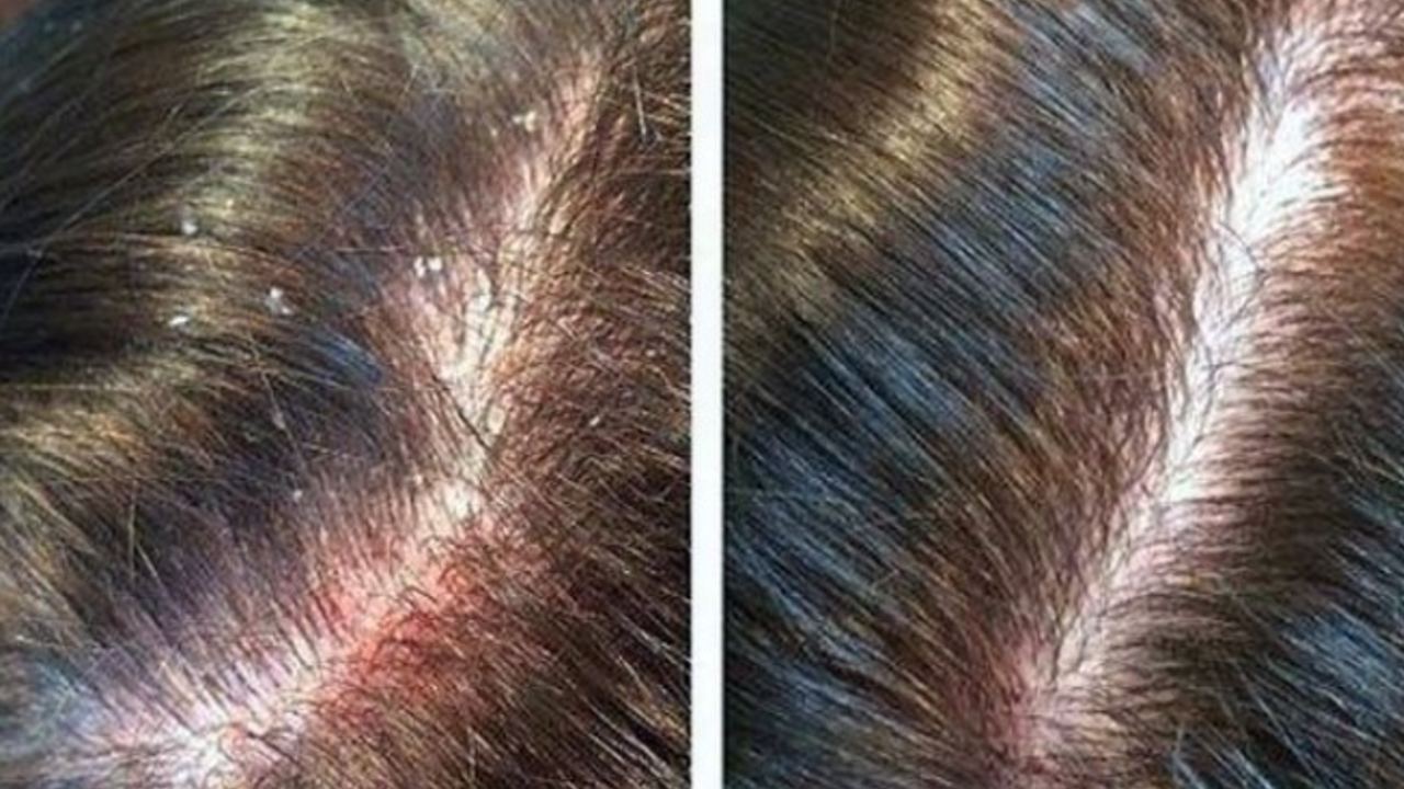 remedio casero contra la caspa con vinagre