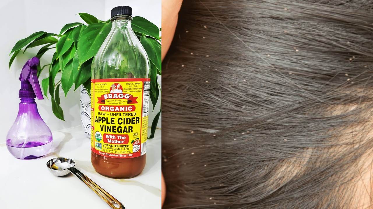 matar a los piojos con vinagre remedios caseros para niños