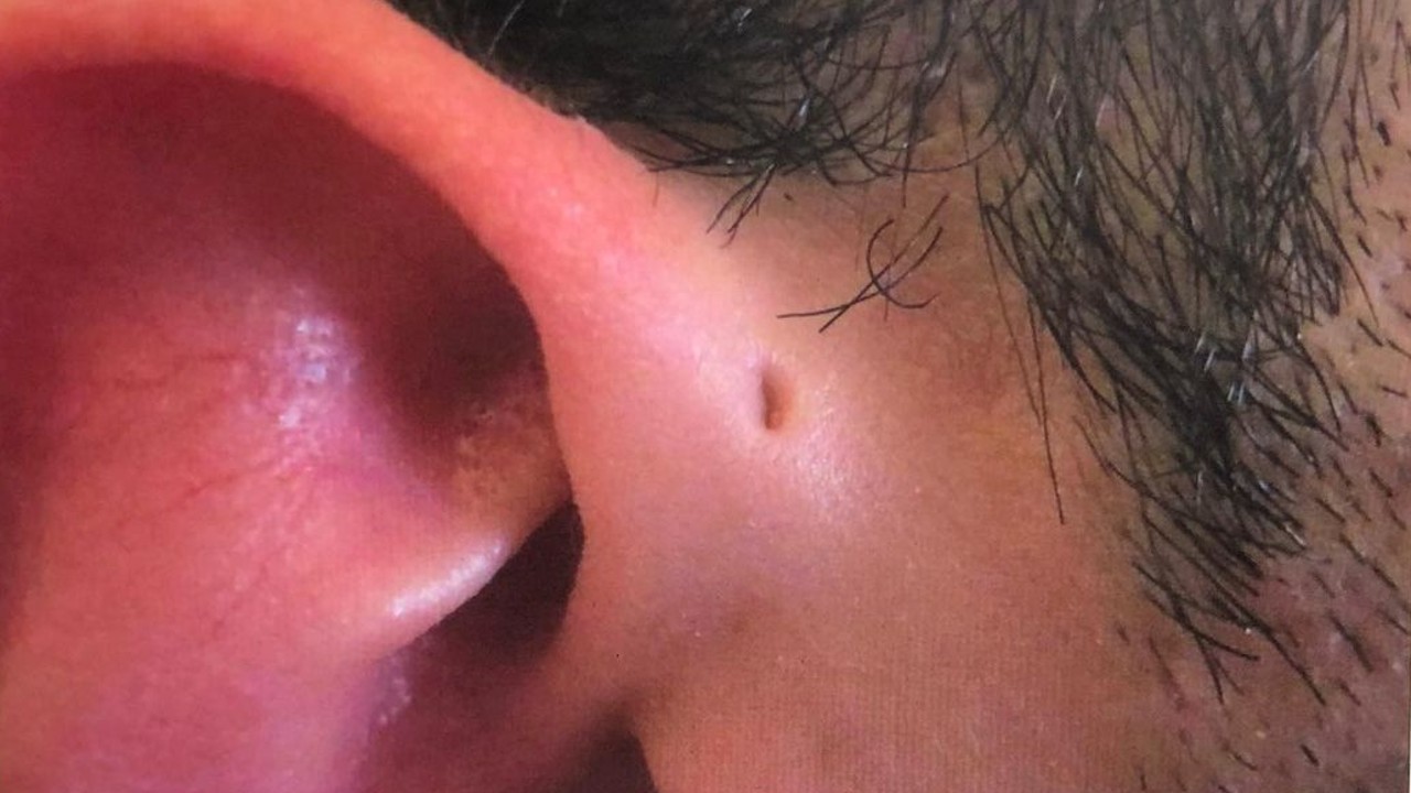 orificio cercano al oído senos preauriculares