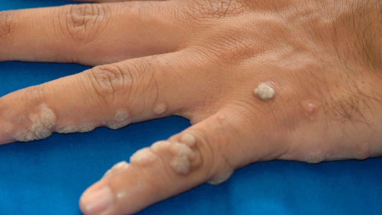 Cómo eliminar los mezquinos de la piel