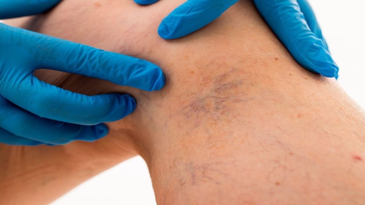 Ejercicios-que-te-ayudaran-a-prevenir-o-reducir-las-varices