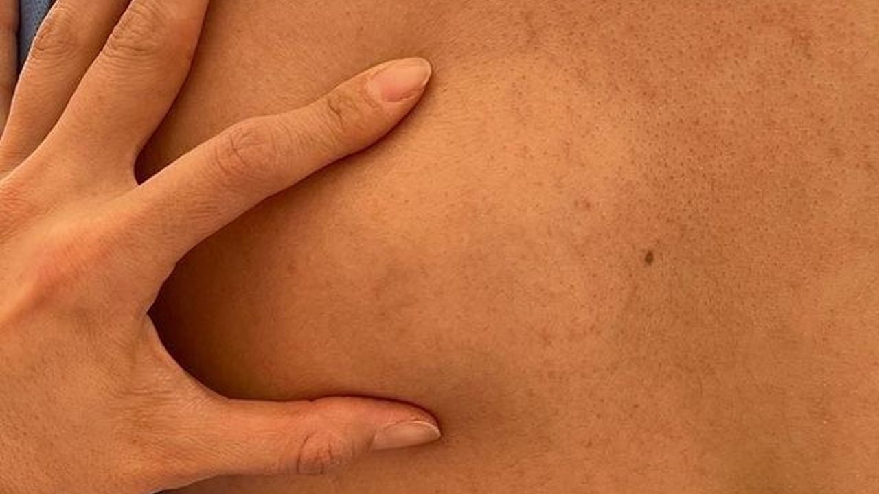 signos y sintomas de lipomas