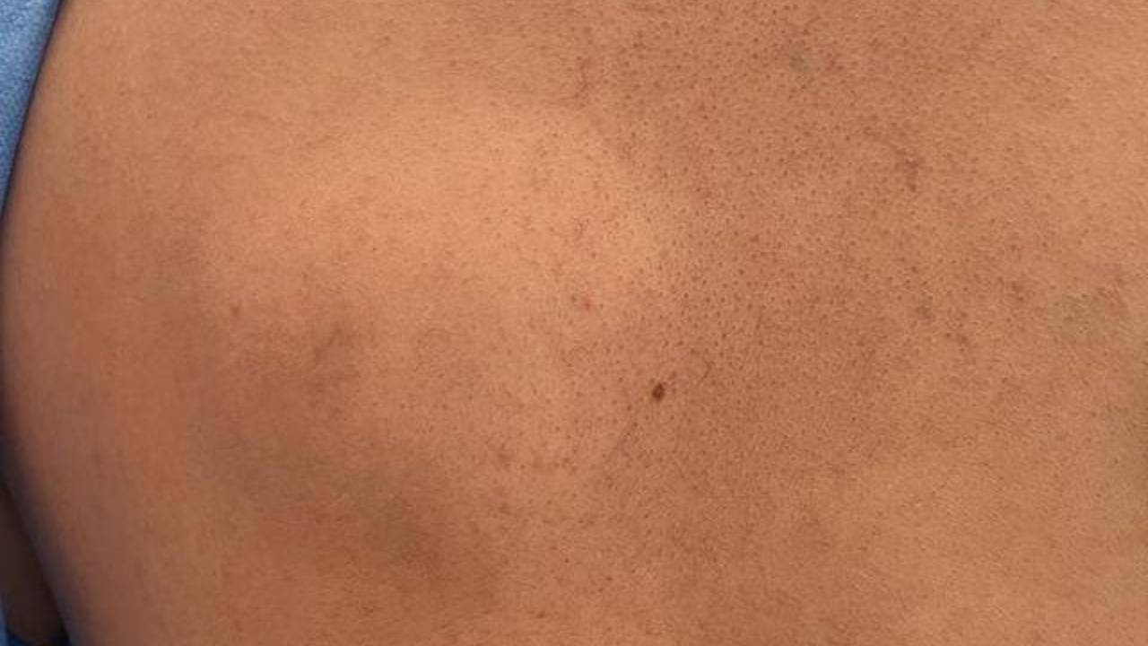 como saber si lipoma es peligroso