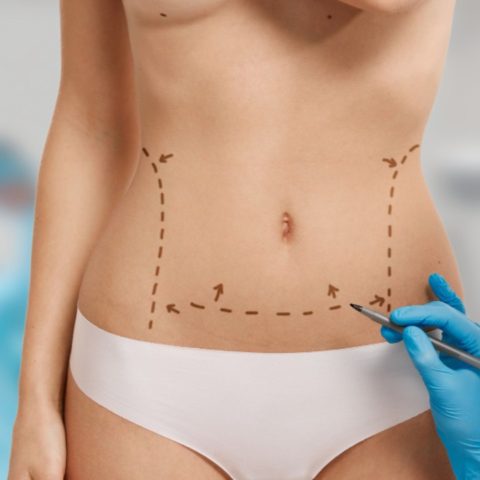 qué comer antes y después de una liposucción para mejores resultados